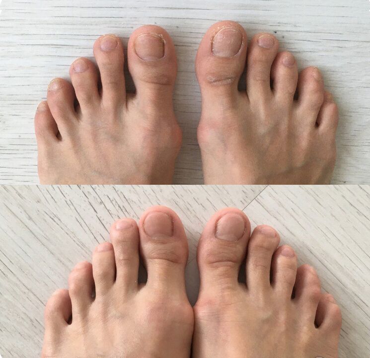 antes e depois de usar spray Foot Tropper